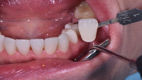 Почему гниют зубы